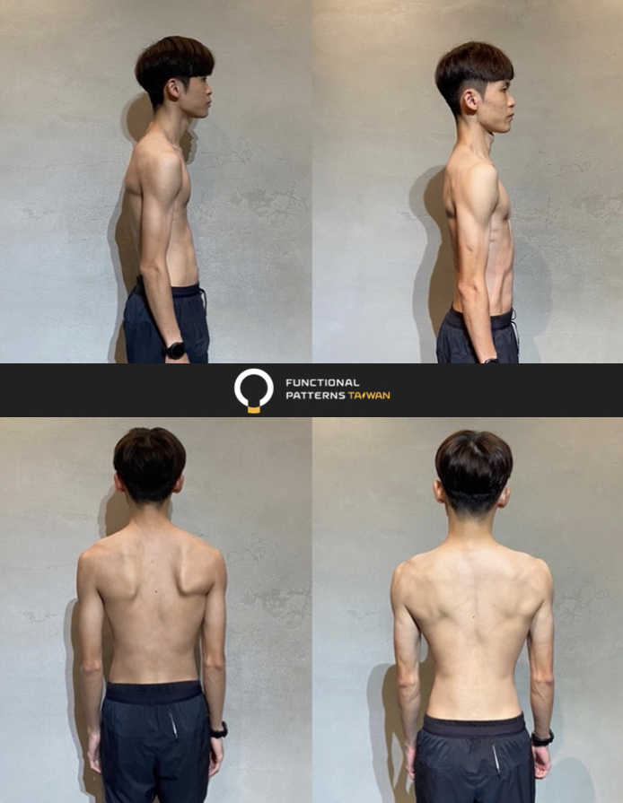站姿優化、翼狀肩胛改善