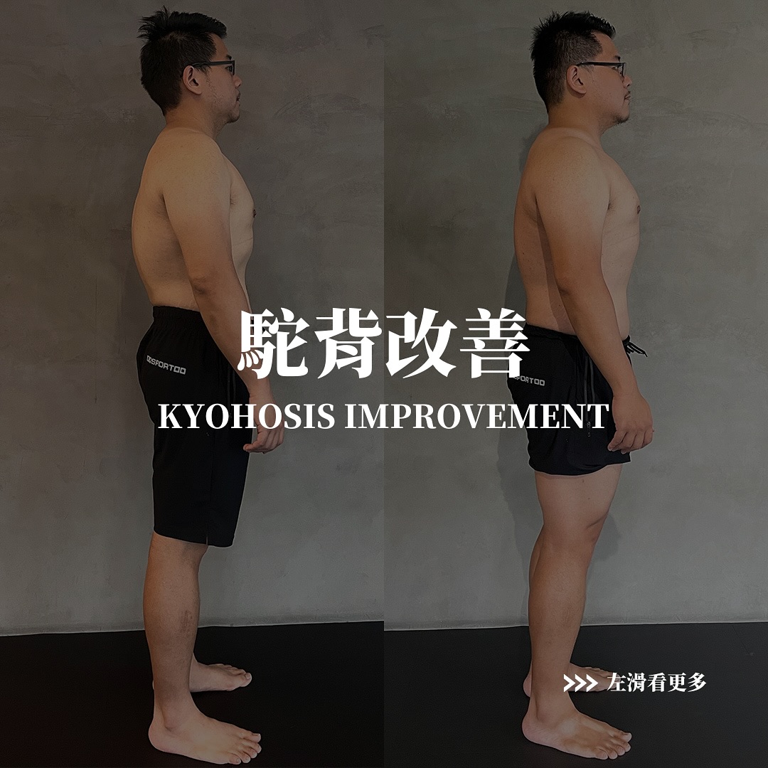 「駝背改善」