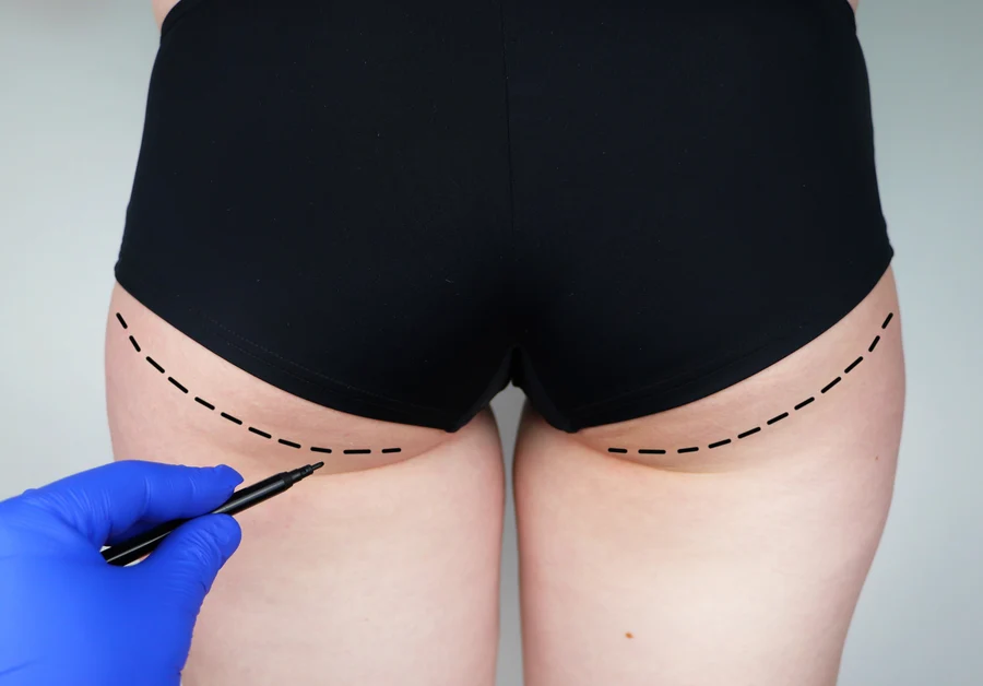 巴西提臀手術（Brazilian Butt Lift, BBL）的風險與其他不良後果